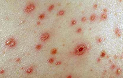 Salud Pública alerta sobre posible brote de varicela en el Café de Herrera